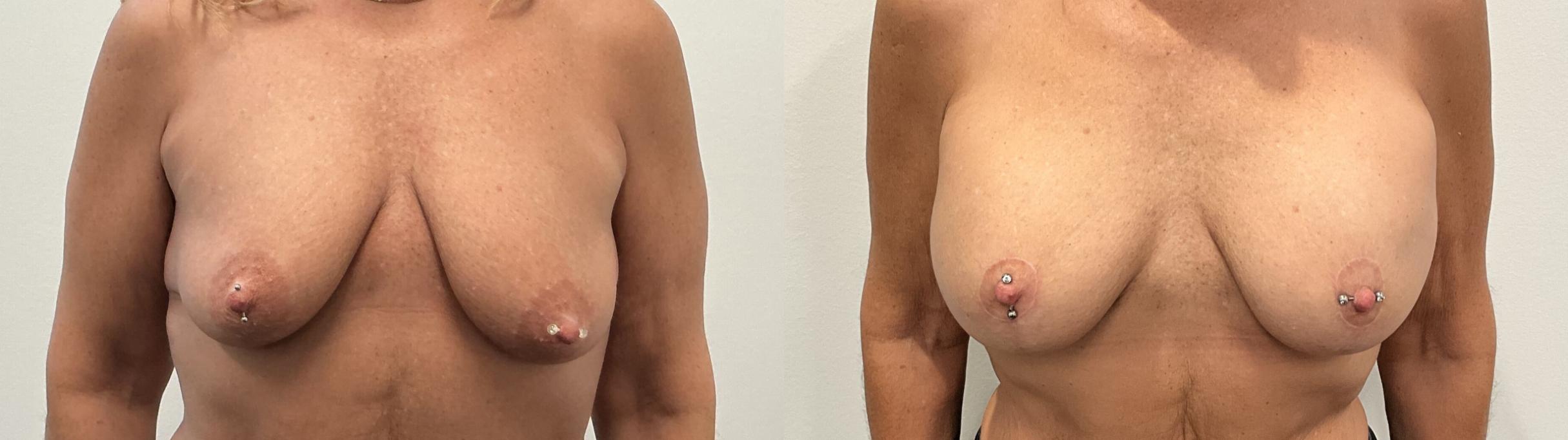 Before & After Breast Augmentation Case 483 Front View in Albany, Latham & Saratoga, New York