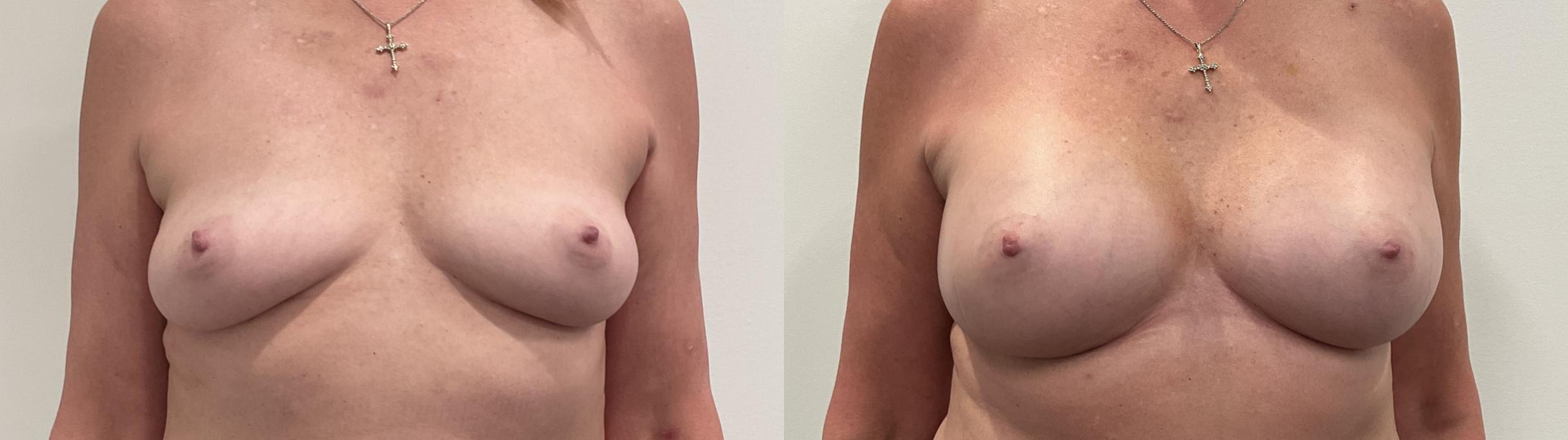 Before & After Breast Augmentation Case 489 Front View in Albany, Latham & Saratoga, New York