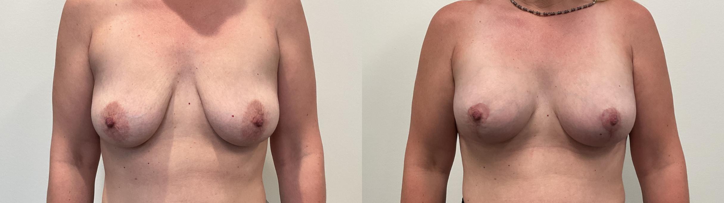 Before & After Breast Lift Case 516 Front View in Albany, Latham & Saratoga, New York