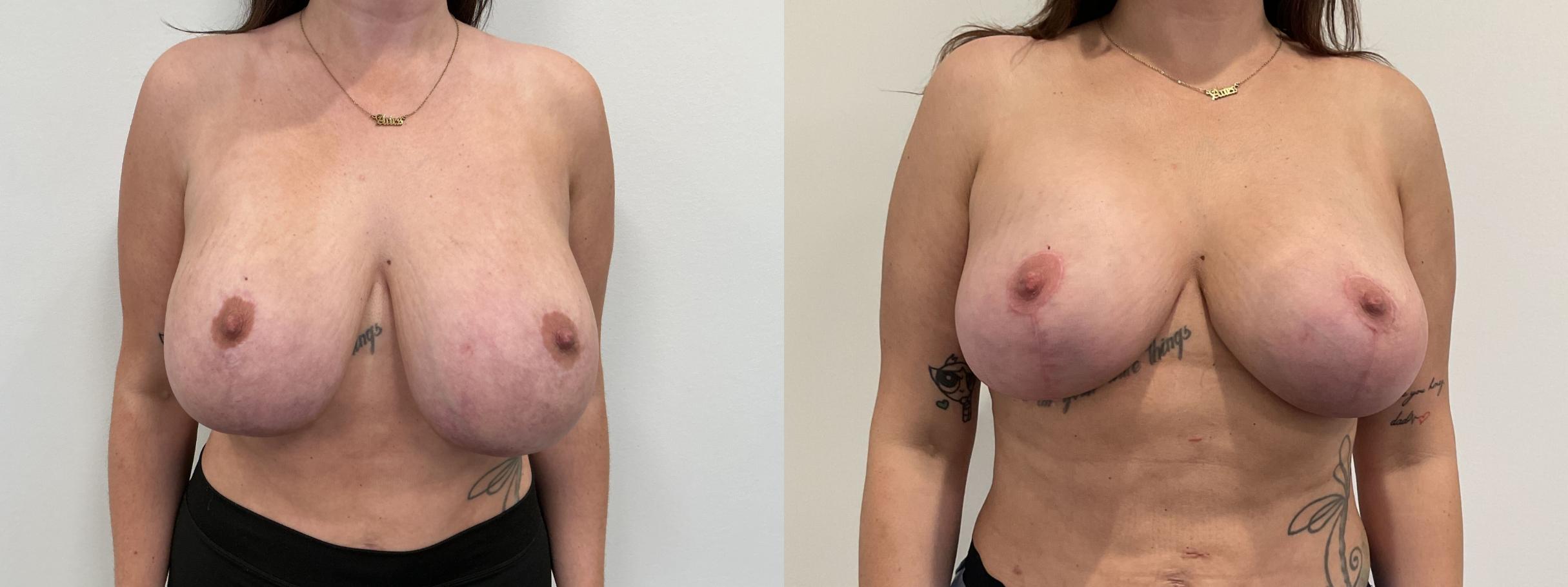 Before & After Breast Augmentation Revision Case 475 Front View in Albany, Latham & Saratoga, New York