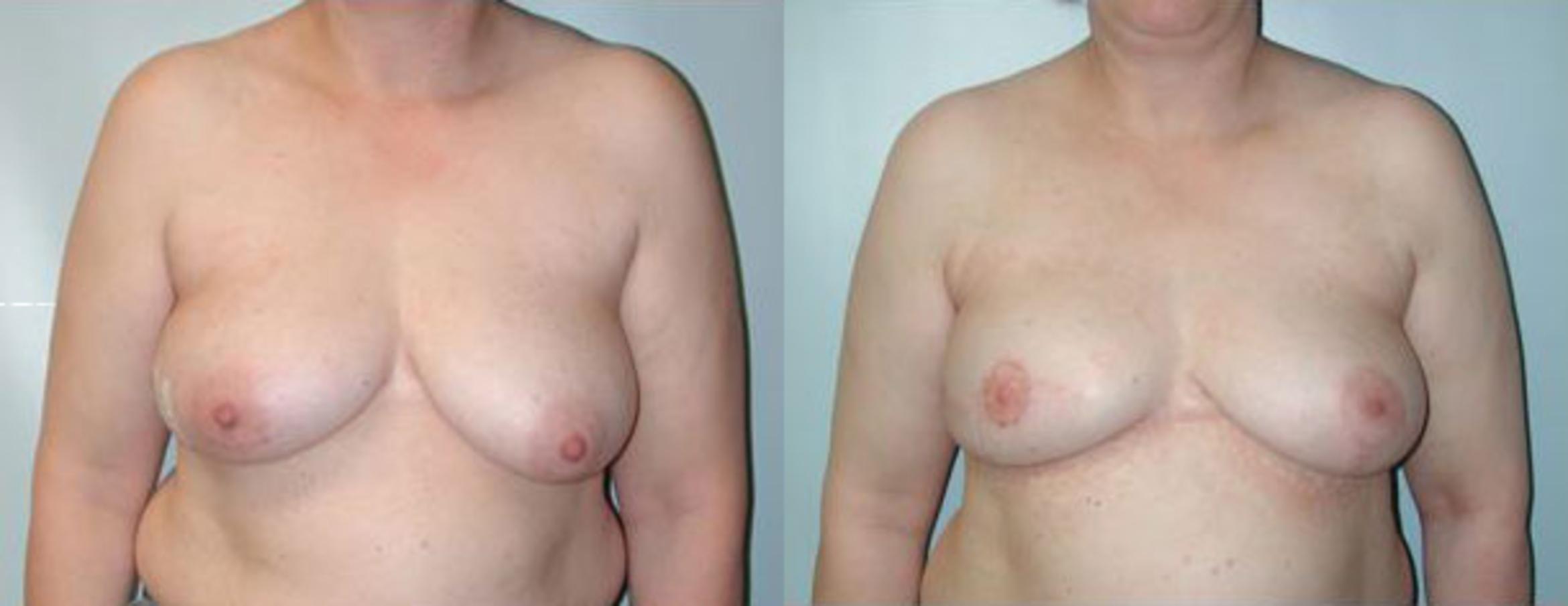 Before & After Breast Reconstruction Case 100 View #1 View in Albany & Latham, New York
