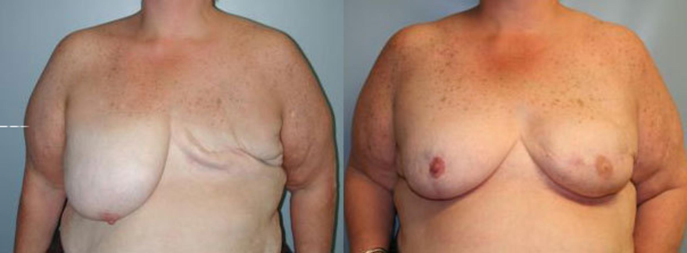 Before & After Breast Reconstruction Case 110 View #1 View in Albany & Latham, New York