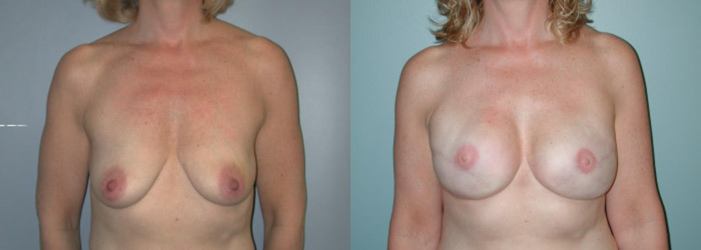 Before & After Breast Reconstruction Case 150 View #1 View in Albany & Latham, New York