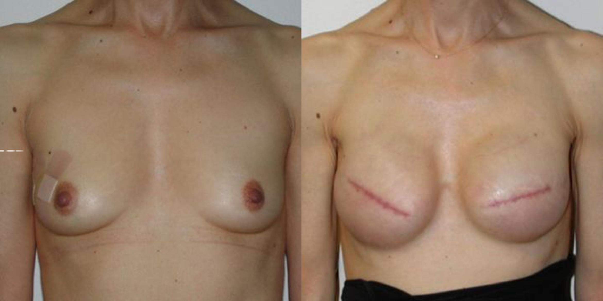 Before & After Breast Reconstruction Case 37 View #1 View in Albany & Latham, New York
