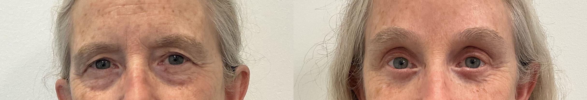 Before & After Brow Lift Case 488 Front View in Albany, Latham & Saratoga, New York