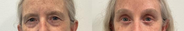 Before & After Brow Lift Case 488 Front View in Albany, Latham & Saratoga, New York