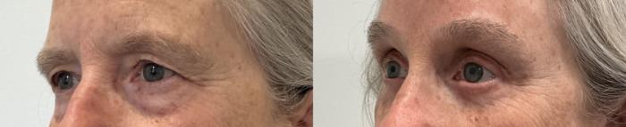 Before & After Brow Lift Case 488 Left Oblique View in Albany, Latham & Saratoga, New York