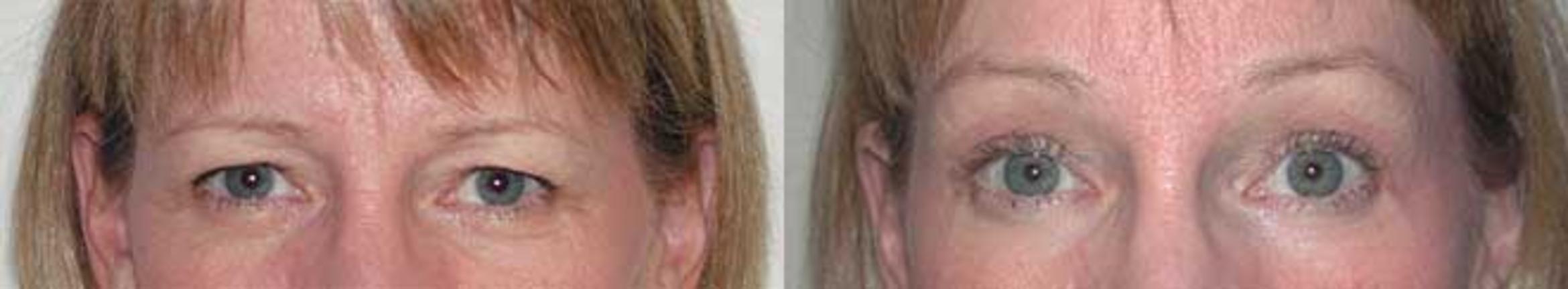 Before & After Brow Lift Case 15 View #1 View in Albany & Latham, New York