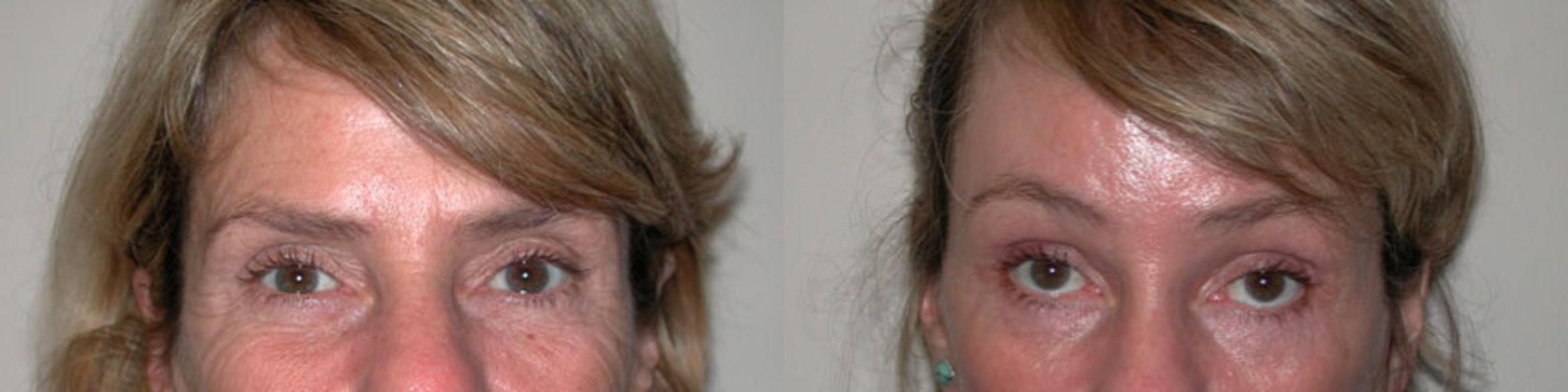 Before & After Brow Lift Case 44 View #1 View in Albany & Latham, New York