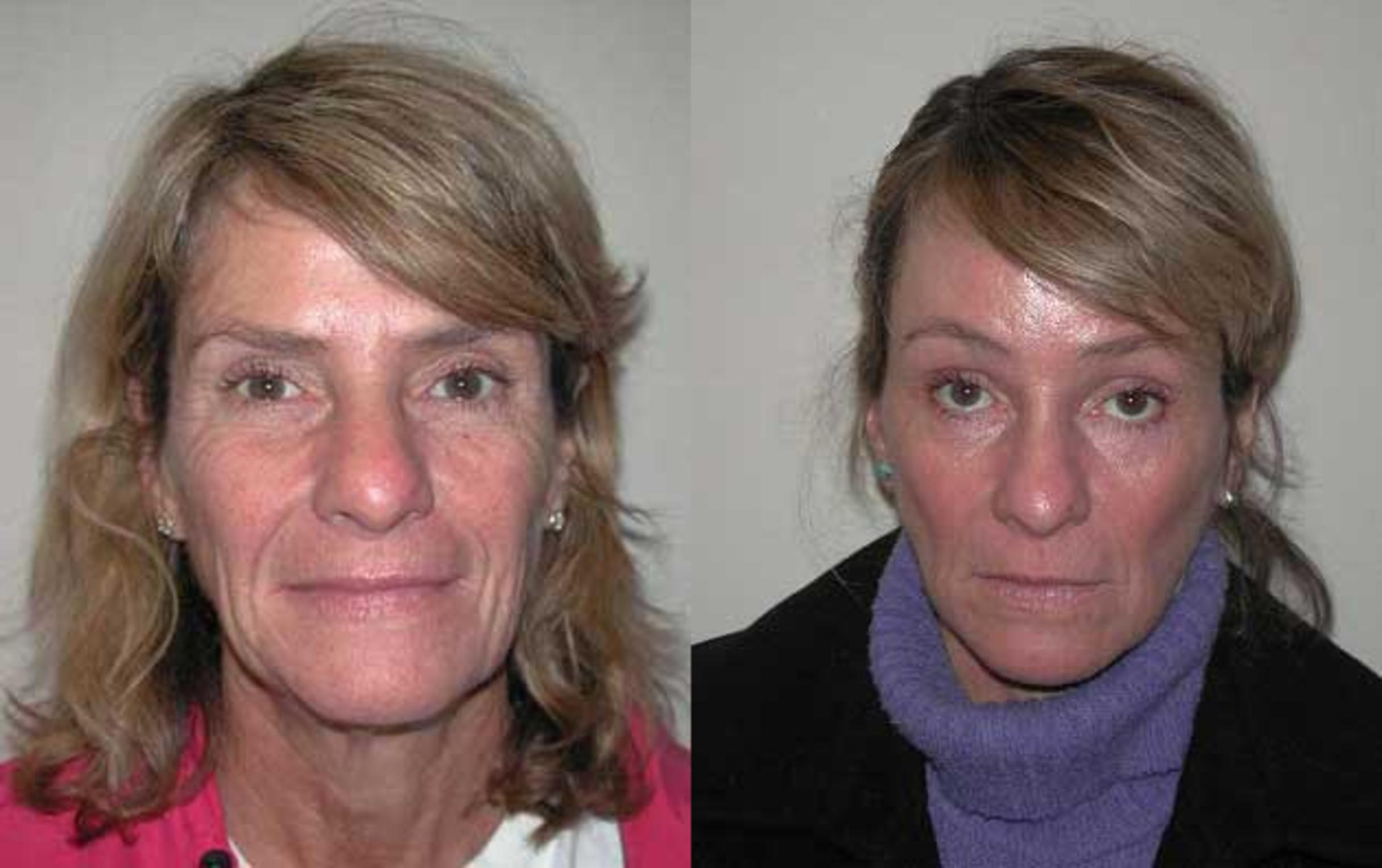 Before & After Facelift Case 56 View #1 View in Albany & Latham, New York