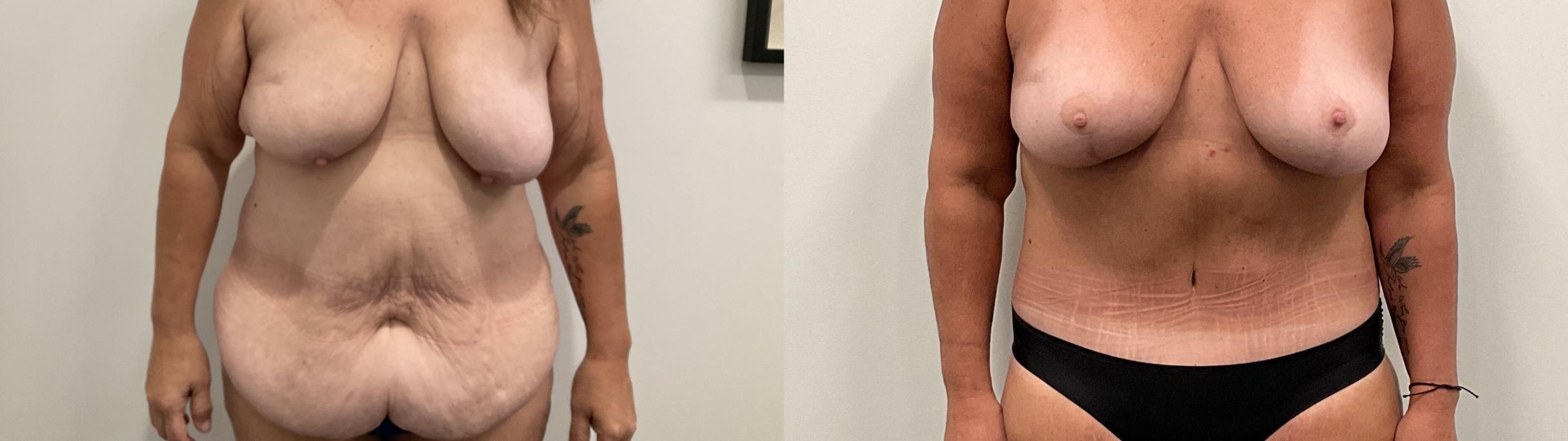 Before & After Breast Lift Case 486 Front View in Albany, Latham & Saratoga, New York