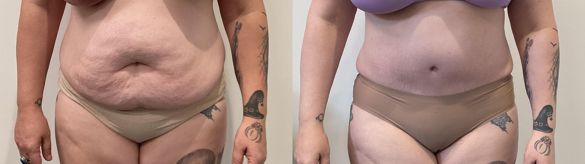 Before & After Tummy Tuck Case 487 Front View in Albany, Latham & Saratoga, New York
