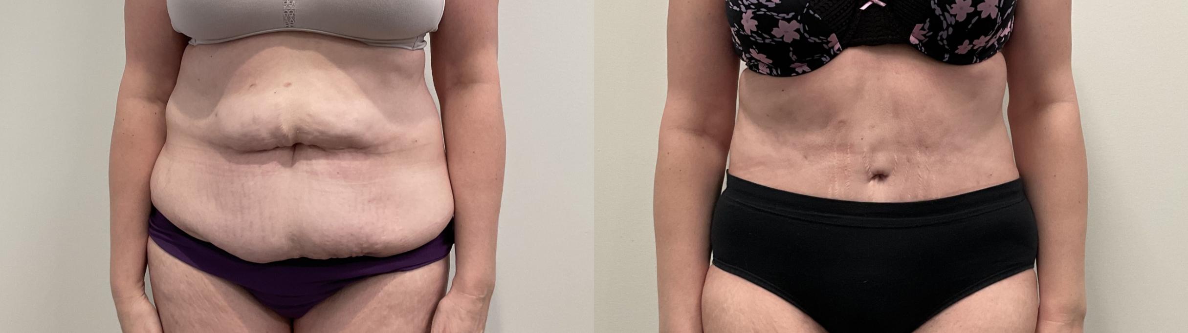 Before & After Tummy Tuck Case 513 Front View in Albany, Latham & Saratoga, New York