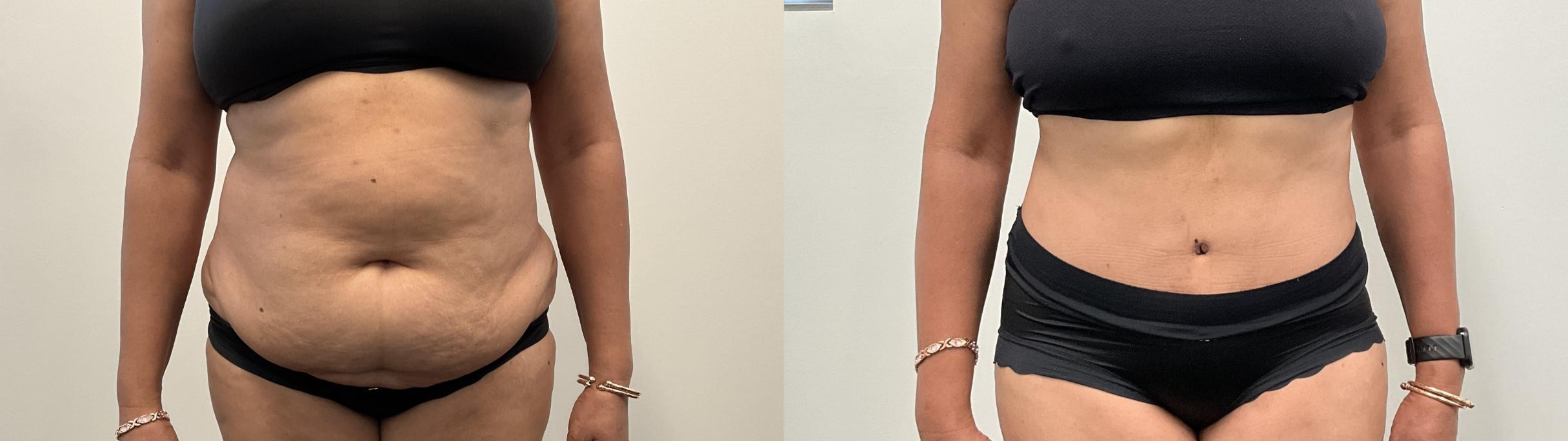 Before & After Tummy Tuck Case 515 Front View in Albany, Latham & Saratoga, New York