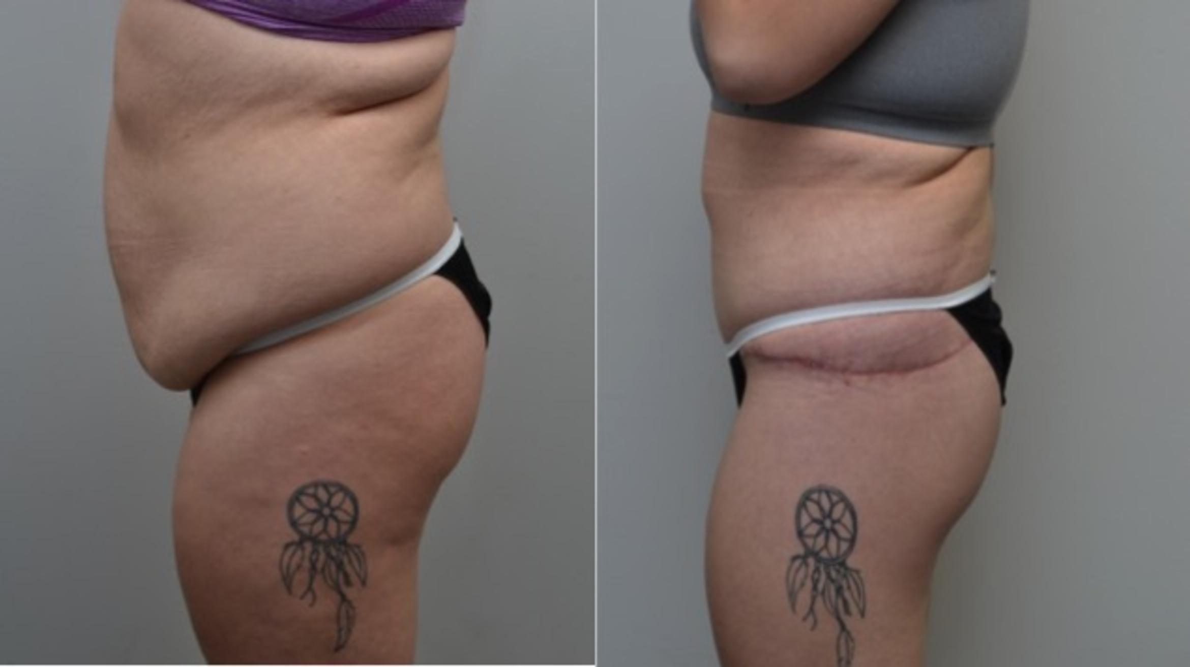 Before & After Body Contouring After Weight Loss Case 278 View #2 View in Albany & Latham, New York