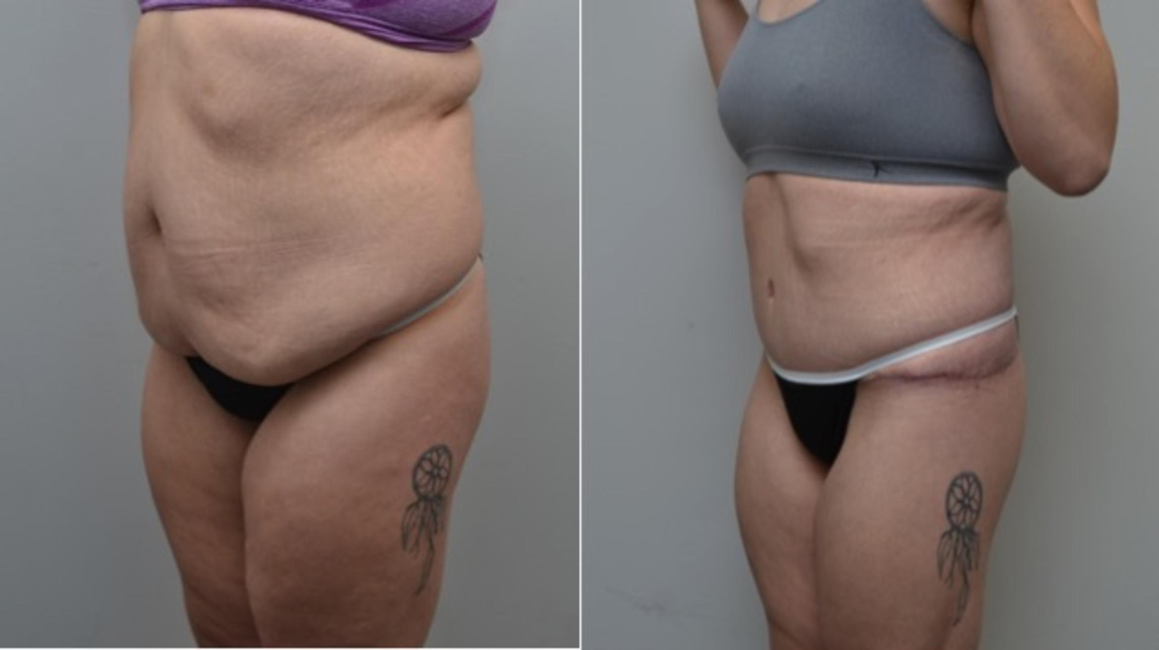 Before & After Body Contouring After Weight Loss Case 278 View #3 View in Albany & Latham, New York