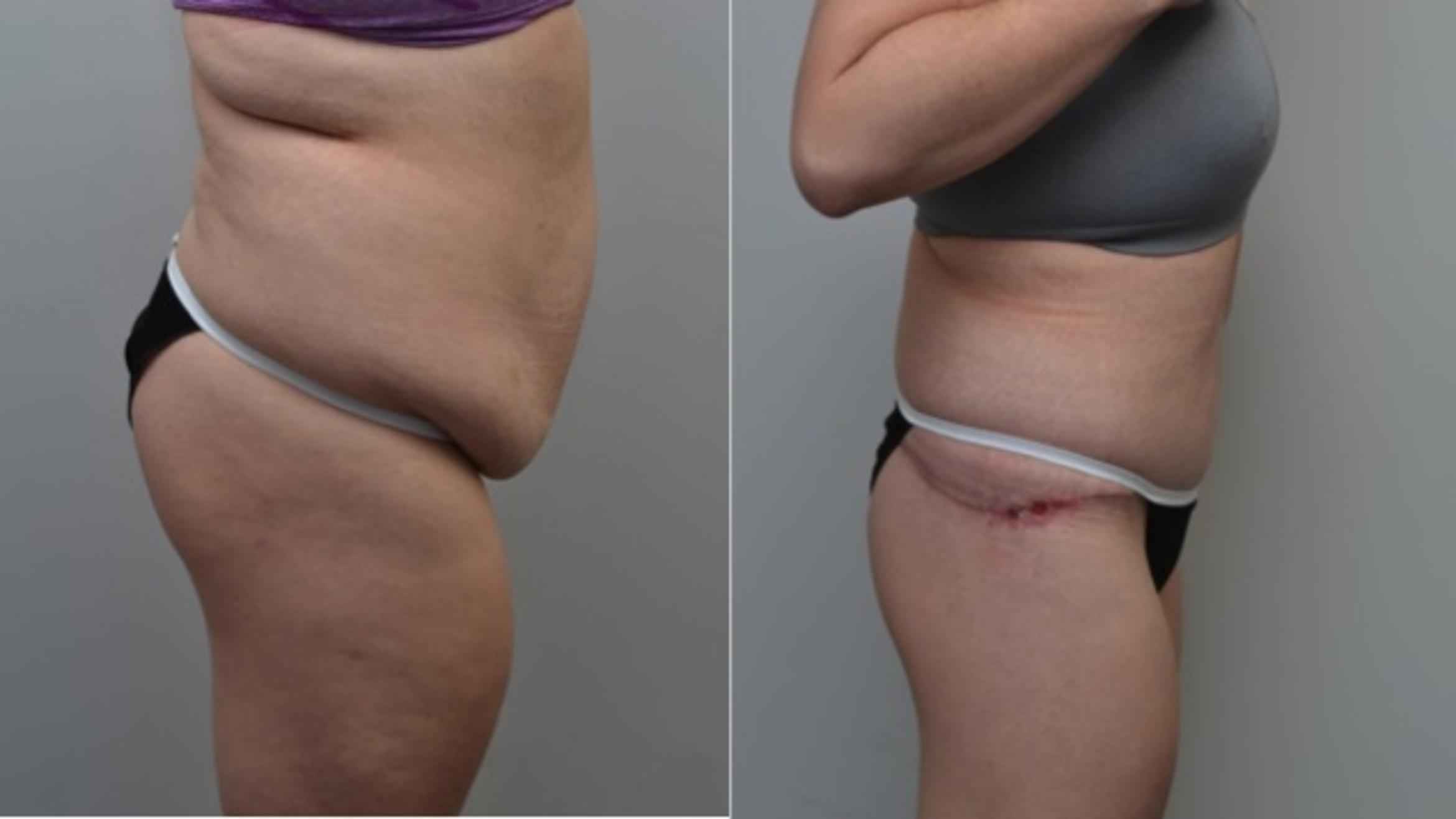 Before & After Body Contouring After Weight Loss Case 278 View #4 View in Albany & Latham, New York
