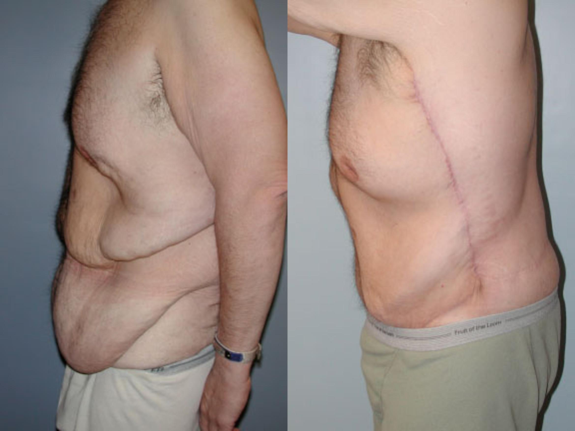Before & After Body Contouring After Weight Loss Case 38 View #2 View in Albany & Latham, New York