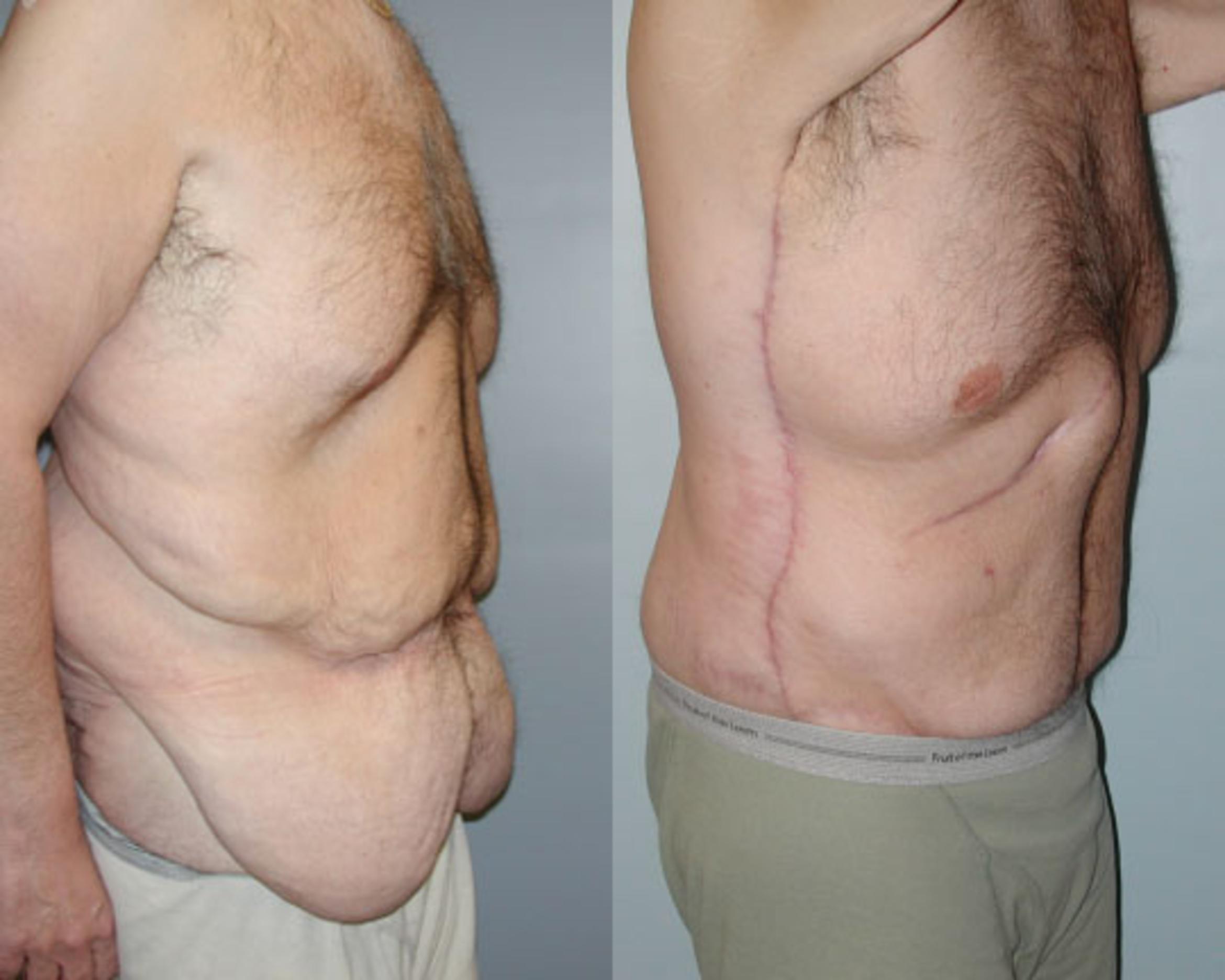 Before & After Body Contouring After Weight Loss Case 38 View #3 View in Albany & Latham, New York