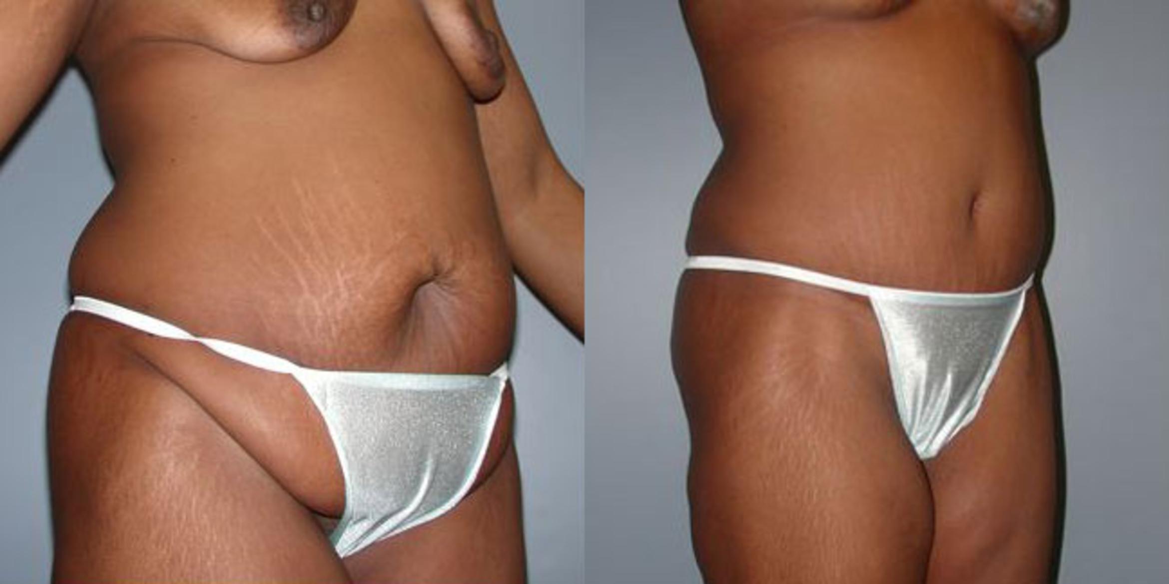 Before & After Body Contouring After Weight Loss Case 71 View #4 View in Albany & Latham, New York