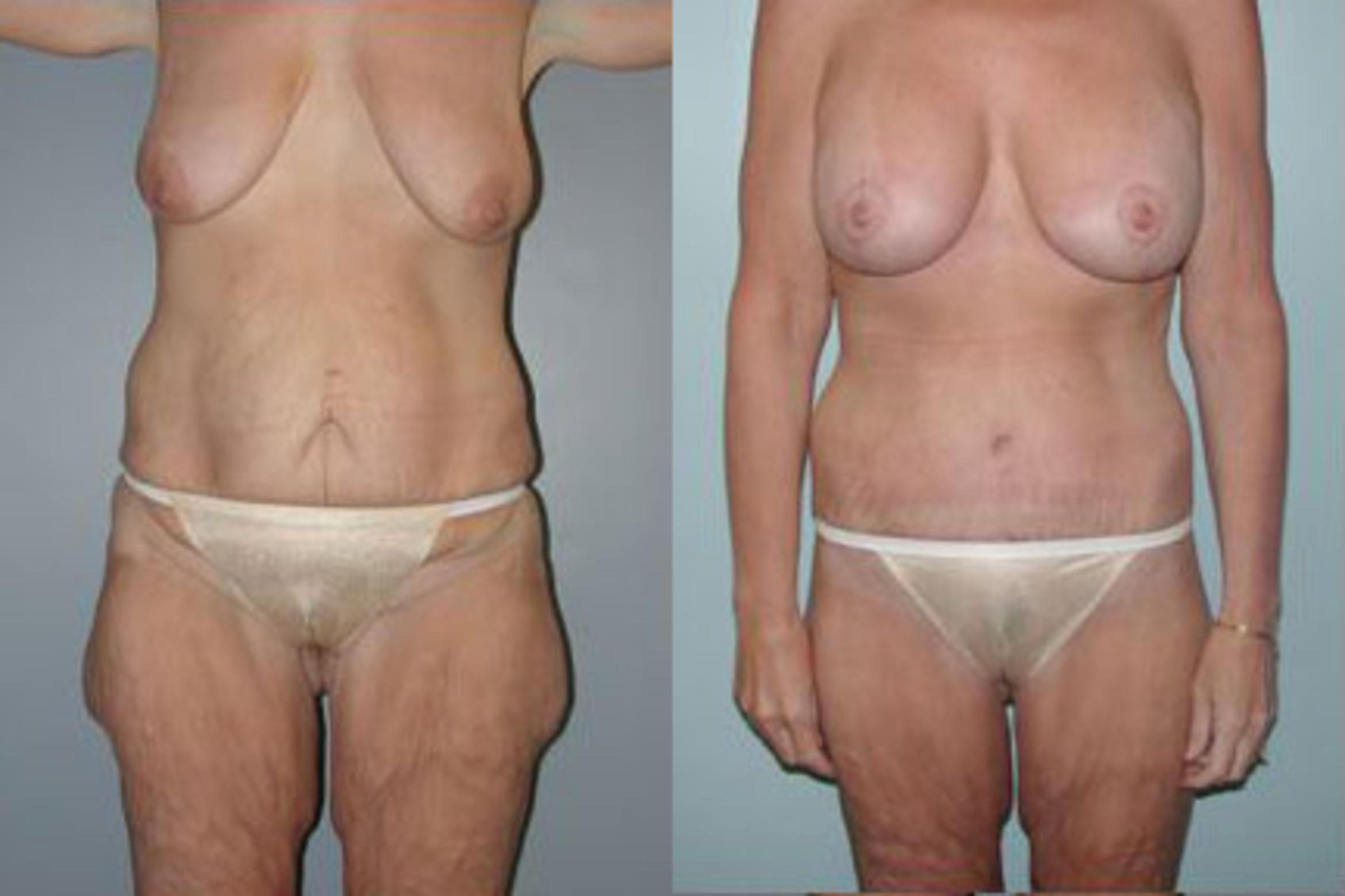 Before & After Body Contouring After Weight Loss Case 87 View #1 View in Albany & Latham, New York