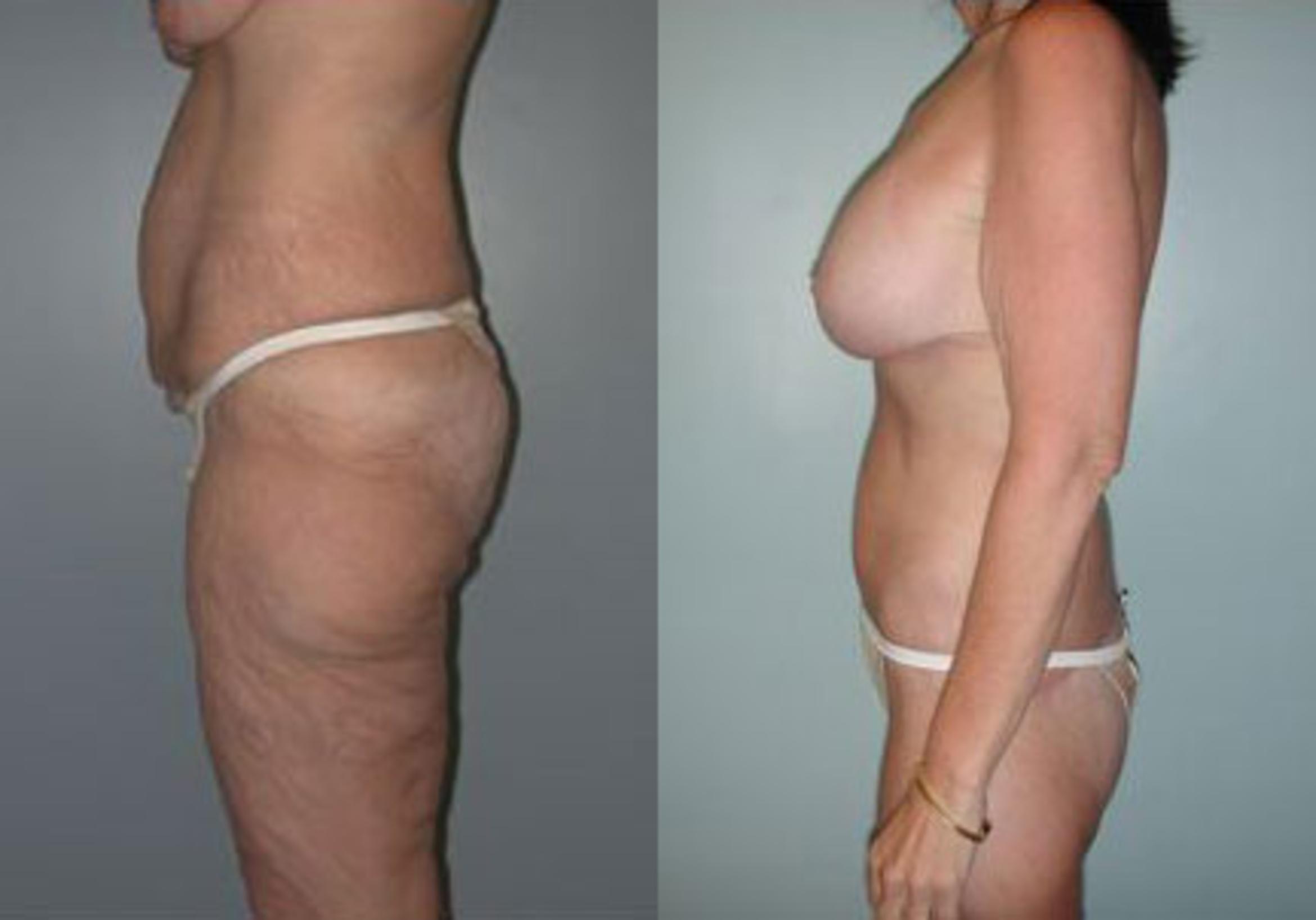 Before & After Body Contouring After Weight Loss Case 87 View #3 View in Albany & Latham, New York