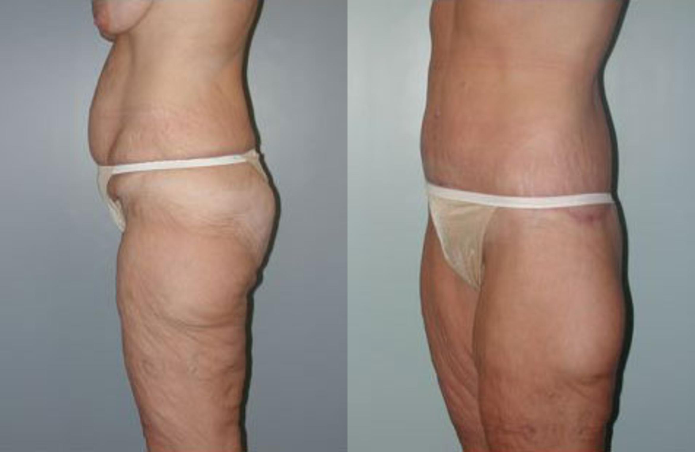 Before & After Body Contouring After Weight Loss Case 87 View #5 View in Albany & Latham, New York