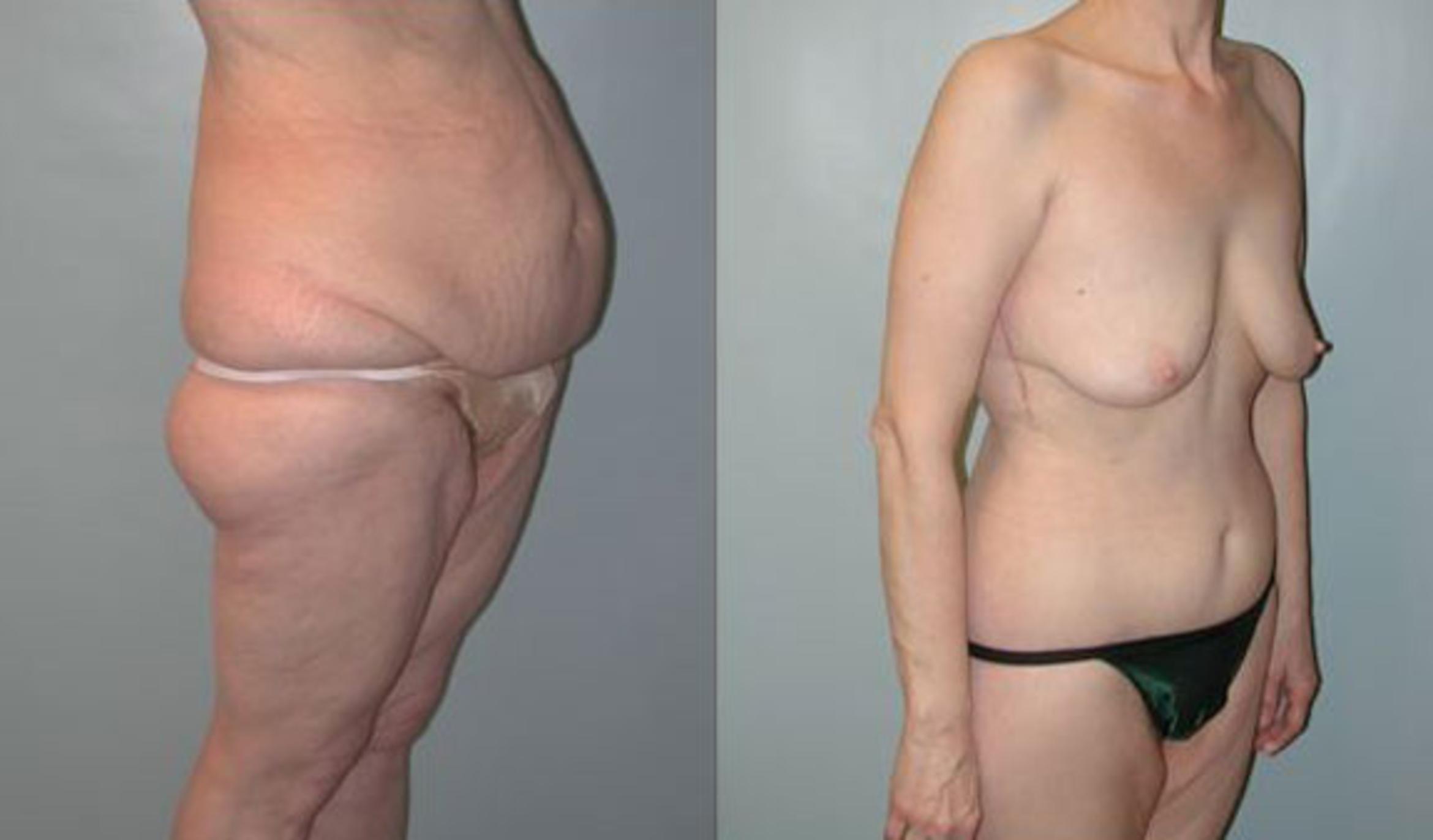 Before & After Body Contouring After Weight Loss Case 96 View #3 View in Albany & Latham, New York