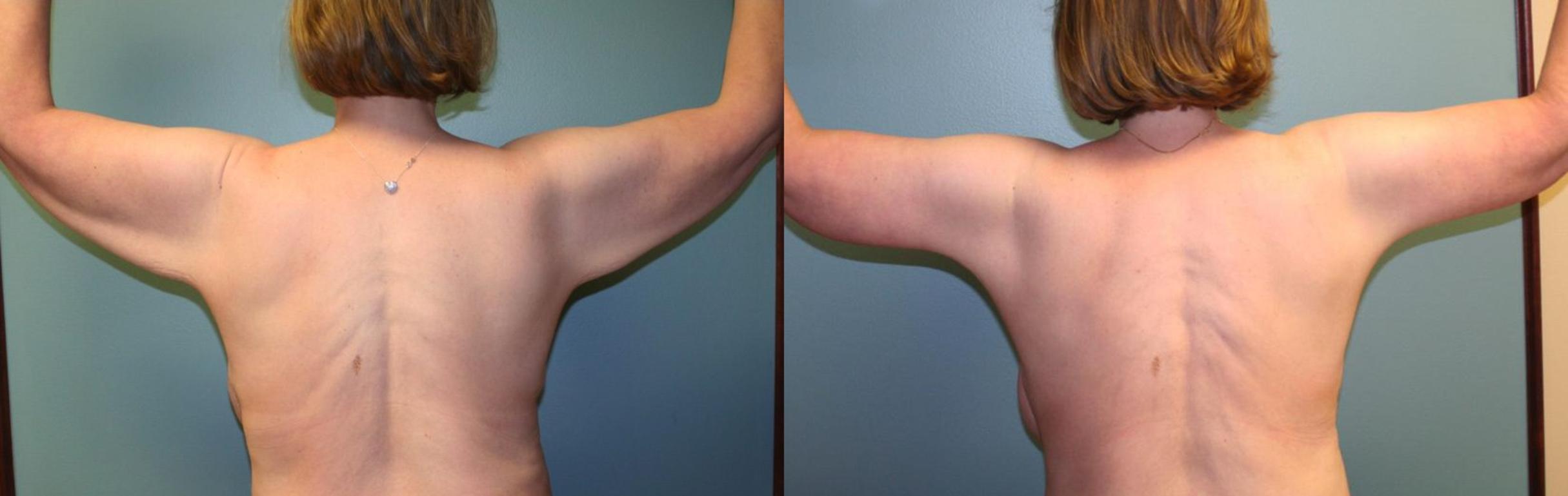 Before & After Arm Lift Case 160 View #1 View in Albany & Latham, New York