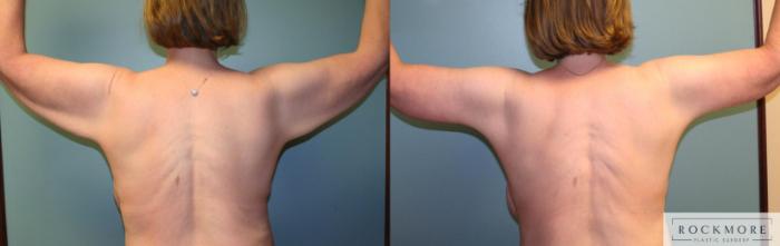 Before & After Arm Lift Case 160 View #1 View in Albany & Latham, New York
