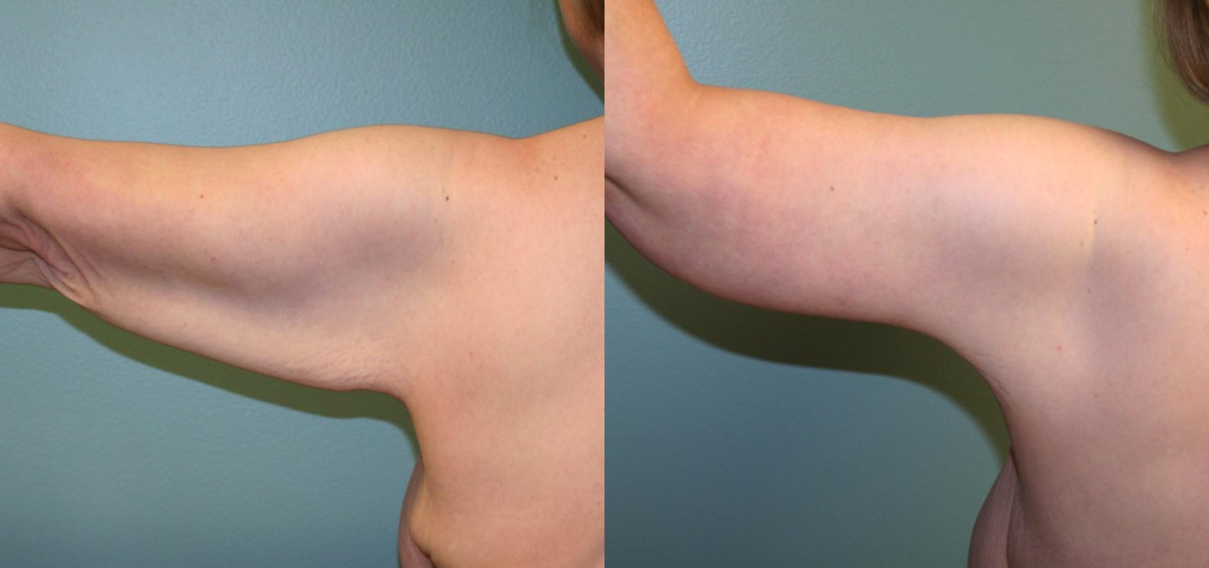 Before & After Arm Lift Case 160 View #2 View in Albany, Latham & Saratoga, New York