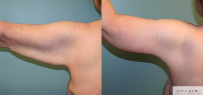 Before & After Arm Lift Case 160 View #2 View in Albany & Latham, New York