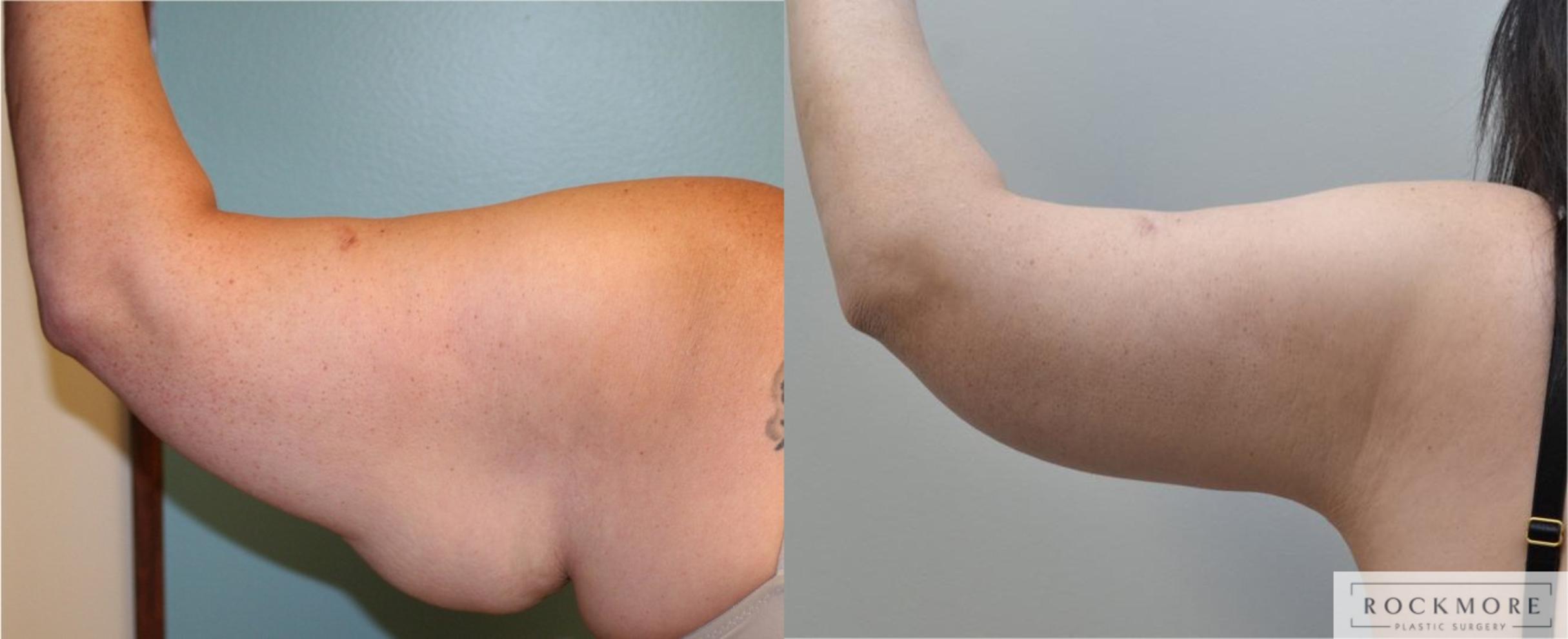 Before & After Arm Lift Case 201 View #1 View in Albany & Latham, New York