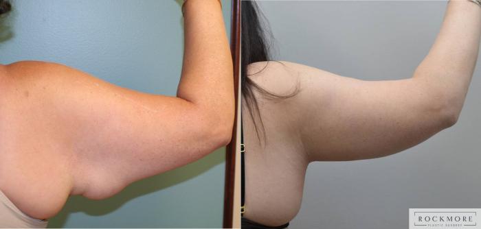 Before & After Arm Lift Case 201 View #2 View in Albany & Latham, New York