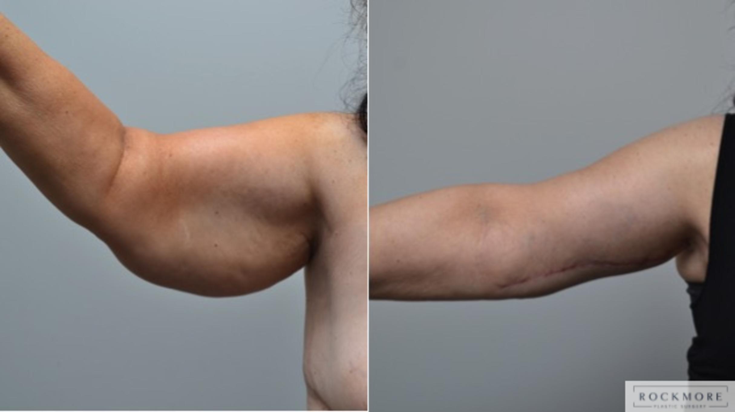 Before & After Arm Lift Case 271 View #1 View in Albany & Latham, New York