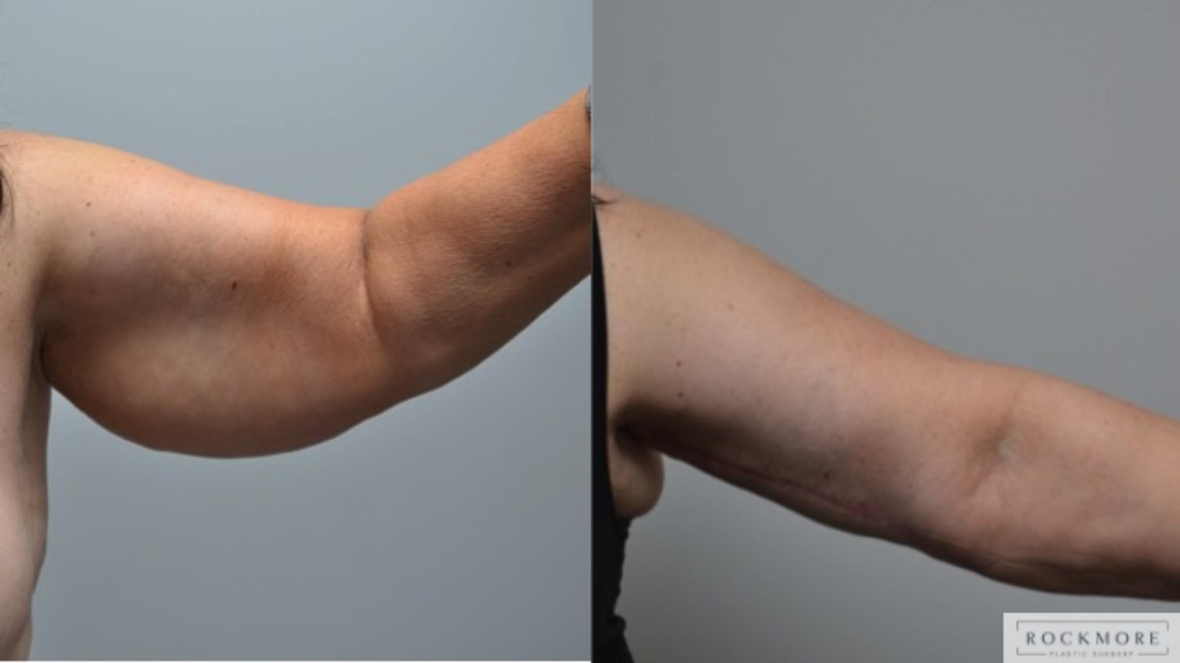 Before & After Arm Lift Case 271 View #2 View in Albany & Latham, New York