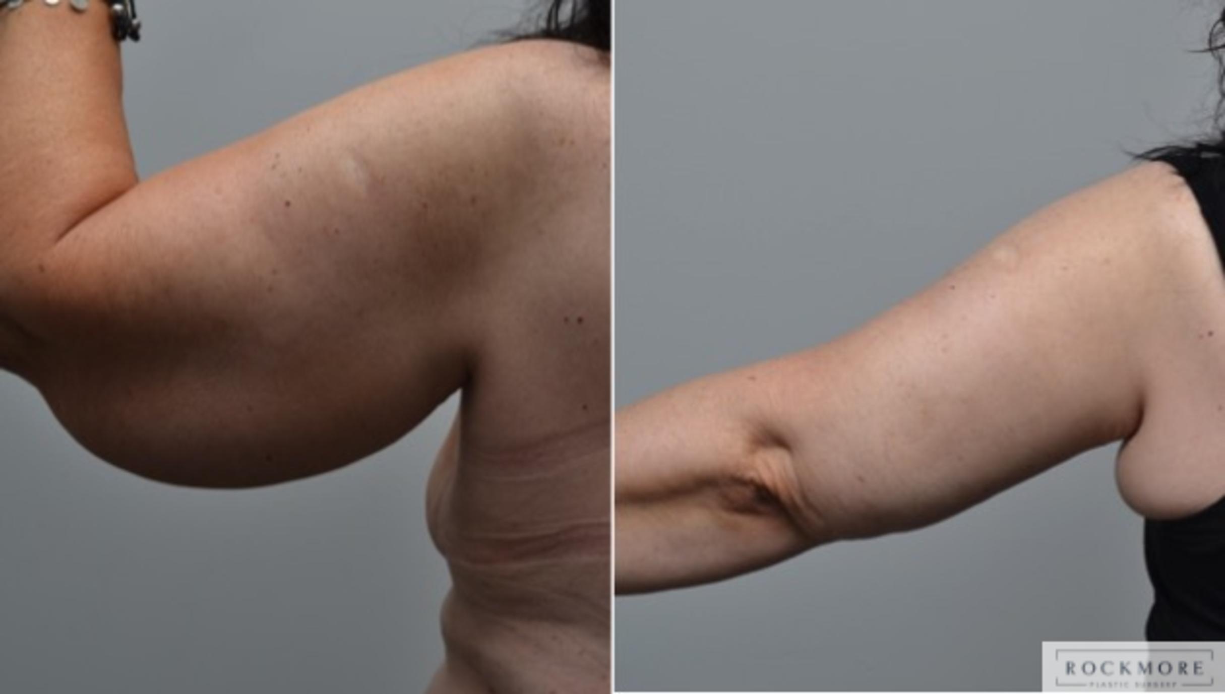 Before & After Arm Lift Case 271 View #3 View in Albany & Latham, New York