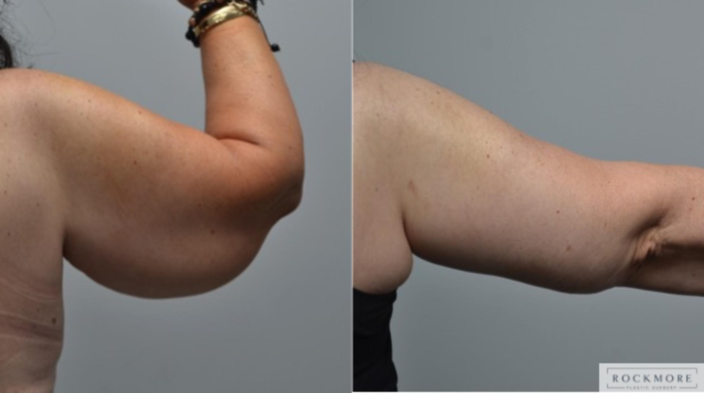 Before & After Arm Lift Case 271 View #4 View in Albany & Latham, New York