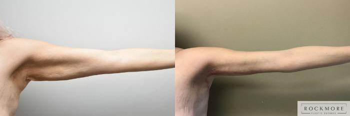 Before & After Arm Lift Case 311 View #2 View in Albany & Latham, New York