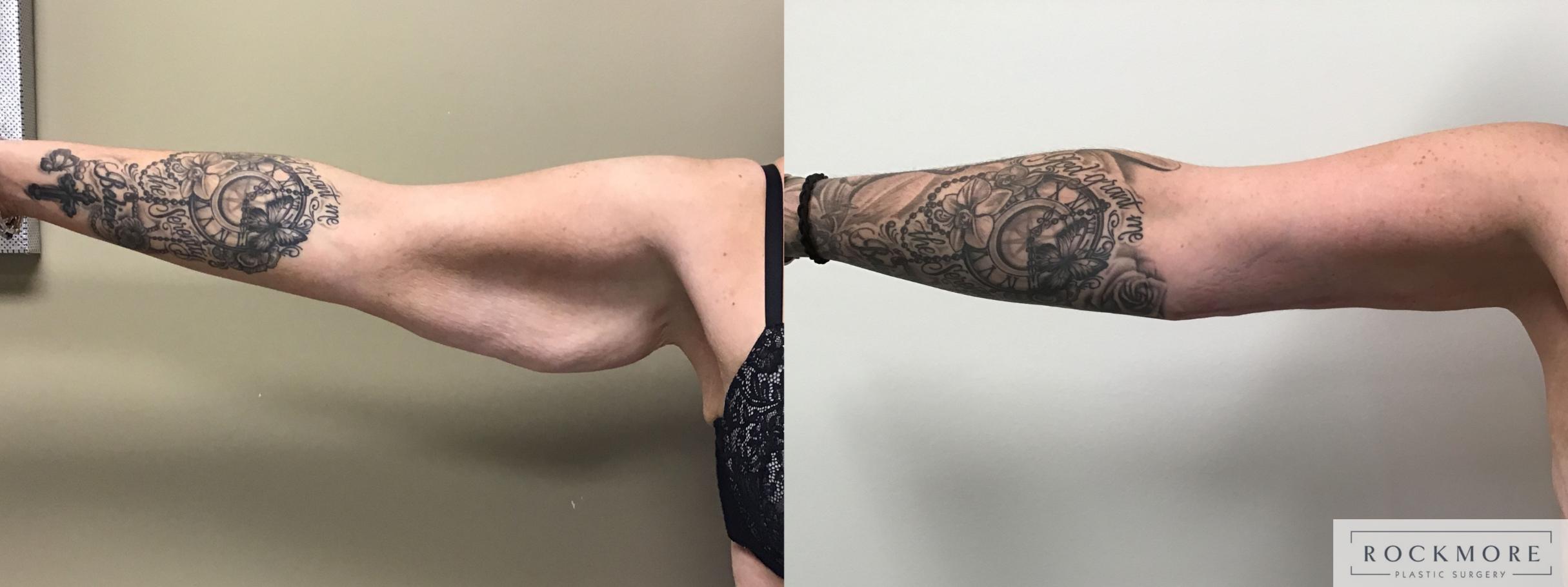 Before & After Arm Lift Case 394 Front View in Albany & Latham, New York