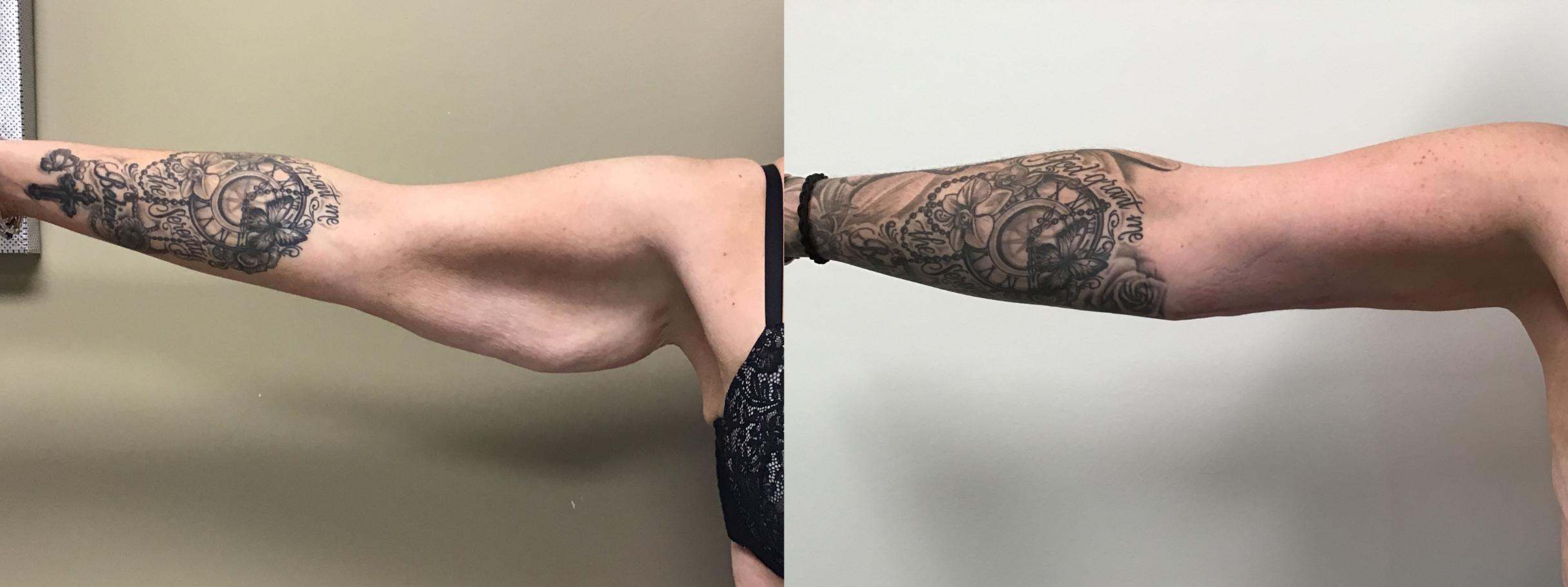 Before & After Arm Lift Case 394 Front View in Albany, Latham & Saratoga, New York