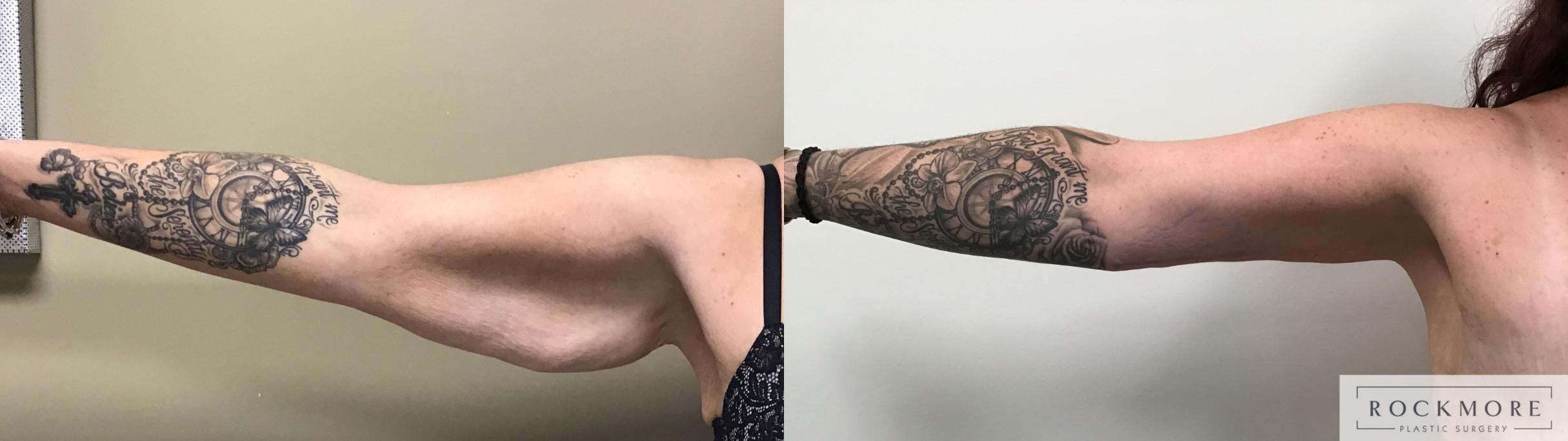Before & After Arm Lift Case 394 Right Side View in Albany & Latham, New York