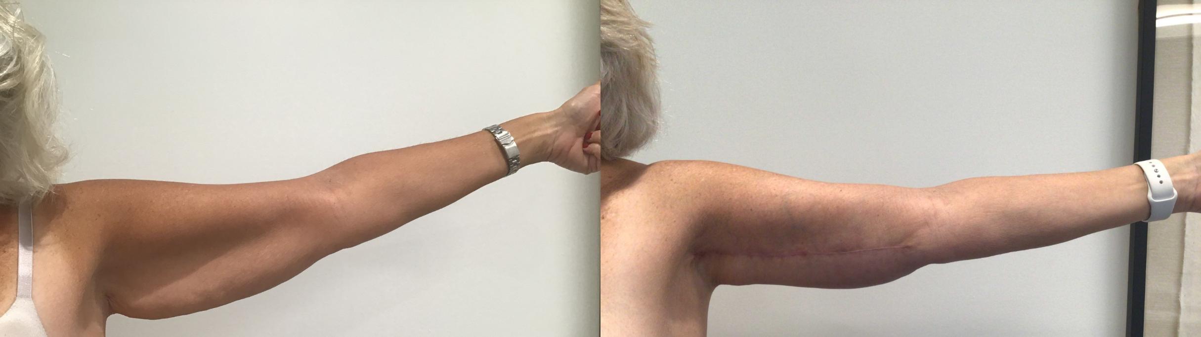 Before & After Arm Lift Case 406 Left Side View in Albany & Latham, New York