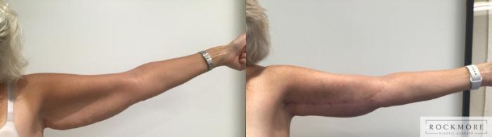 Before & After Arm Lift Case 406 Left Side View in Albany & Latham, New York