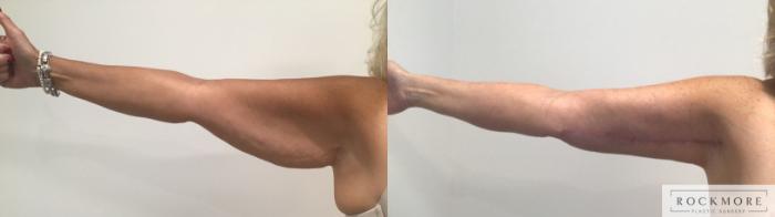 Before & After Arm Lift Case 406 Right Side View in Albany & Latham, New York