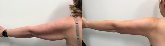 Before & After Arm Lift Case 472 Back Left View in Albany, Latham & Saratoga, New York