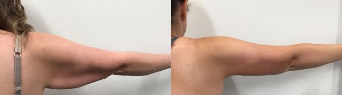 Before & After Arm Lift Case 472 Back Right View in Albany, Latham & Saratoga, New York