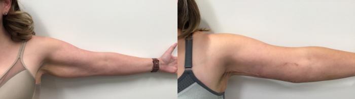 Before & After Arm Lift Case 472 Left Front View in Albany, Latham & Saratoga, New York