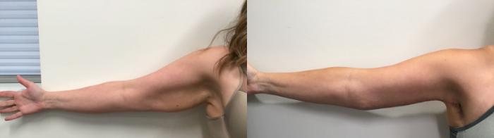 Before & After Arm Lift Case 472 Right Front View in Albany, Latham & Saratoga, New York