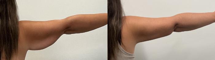 Before & After Arm Lift Case 493 Back Right View in Albany, Latham & Saratoga, New York